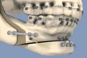 3D dijital planlama ile çene kemikleri milimetrik olarak hedeflenen konuma taşınır, yüz estetiği ve fonksiyon senkronize edilir.
