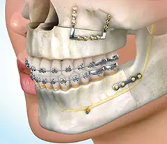 Çift Çene Cerrahisi (Bimaxillary) - tedavi sonucu